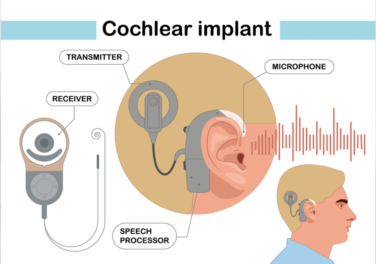 How Does a Cochlear Implant Work? A Simple Guide to Its Main Parts